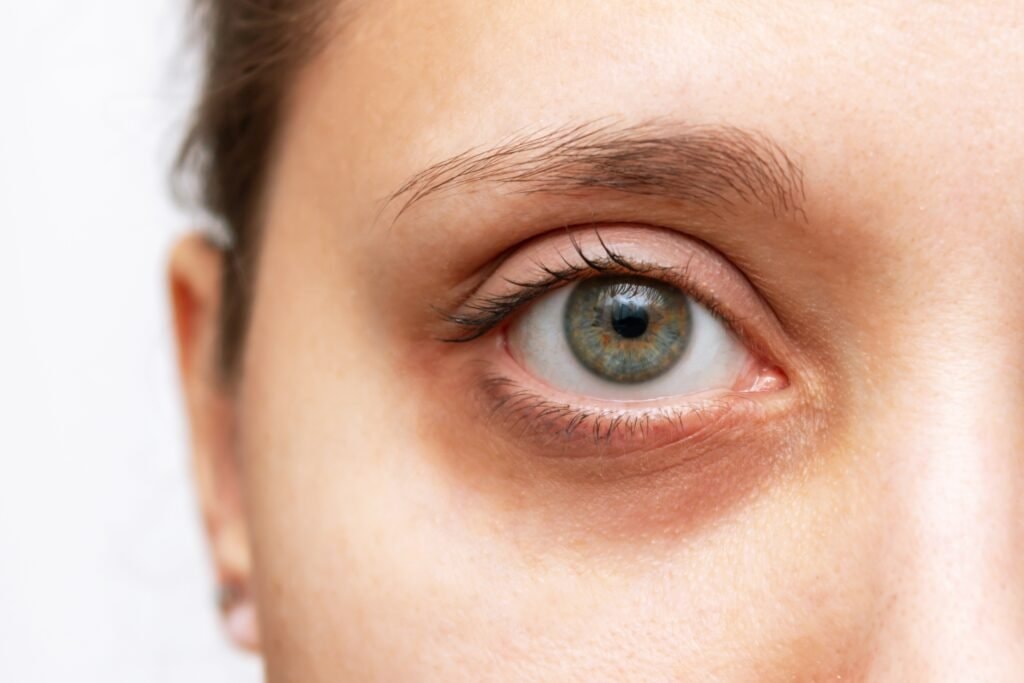 Oogcontour bij Global Eyecon Treatment