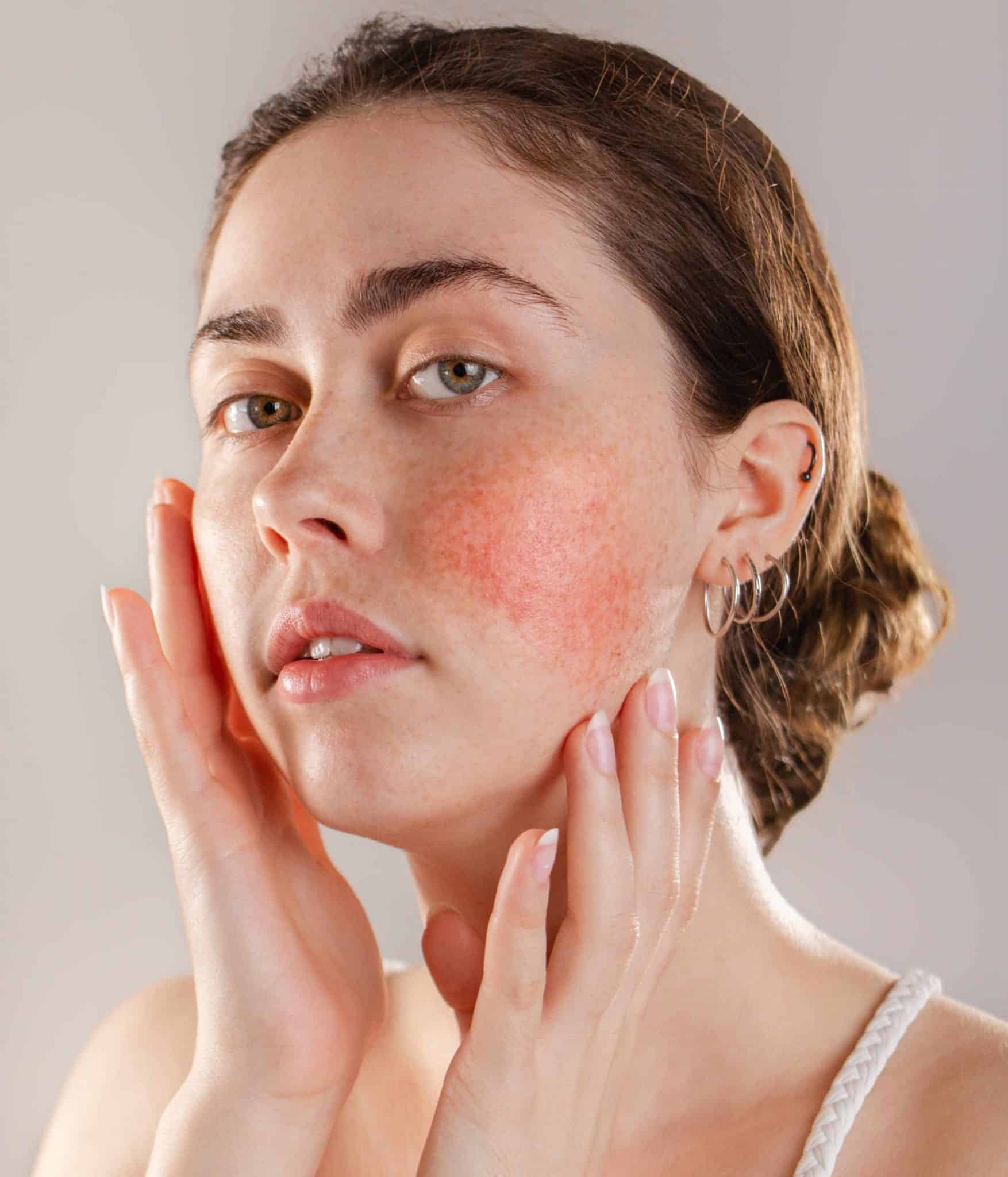 Rosacea hoofdafbeelding